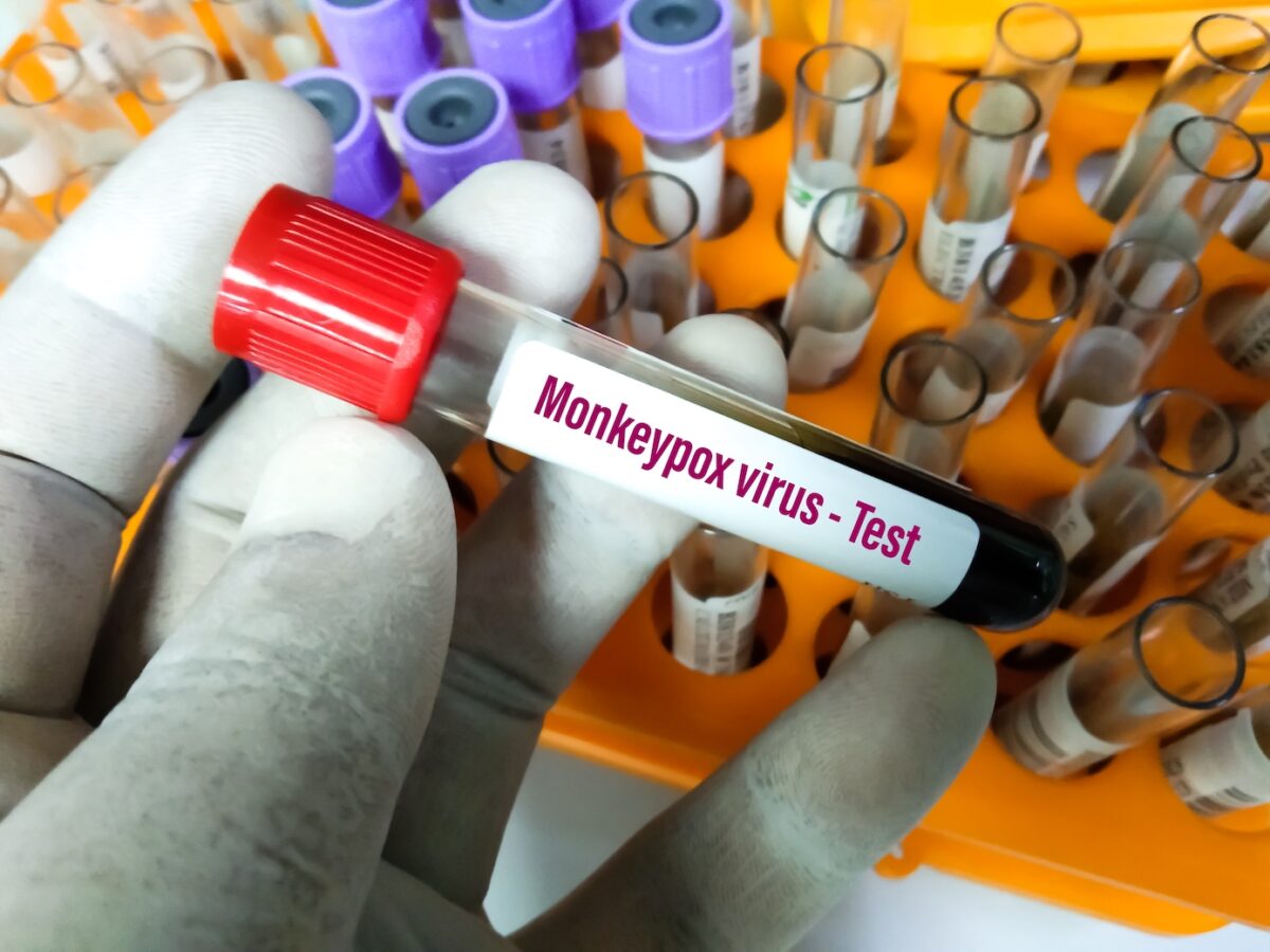 Monkeypox Virus: Facts kontra Fear
