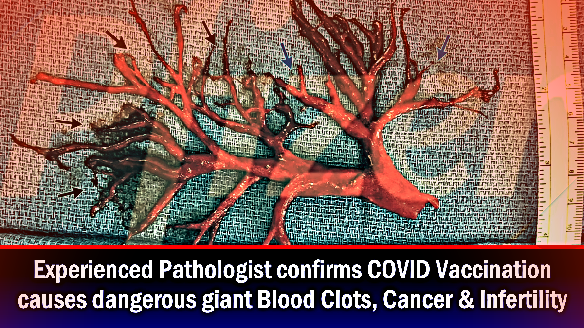 Kinumpirma ng ekspertong pathologist na ang bakuna sa COVID ay nagdudulot ng malalaking pamumuo ng dugo, kanser at kawalan ng katabaan